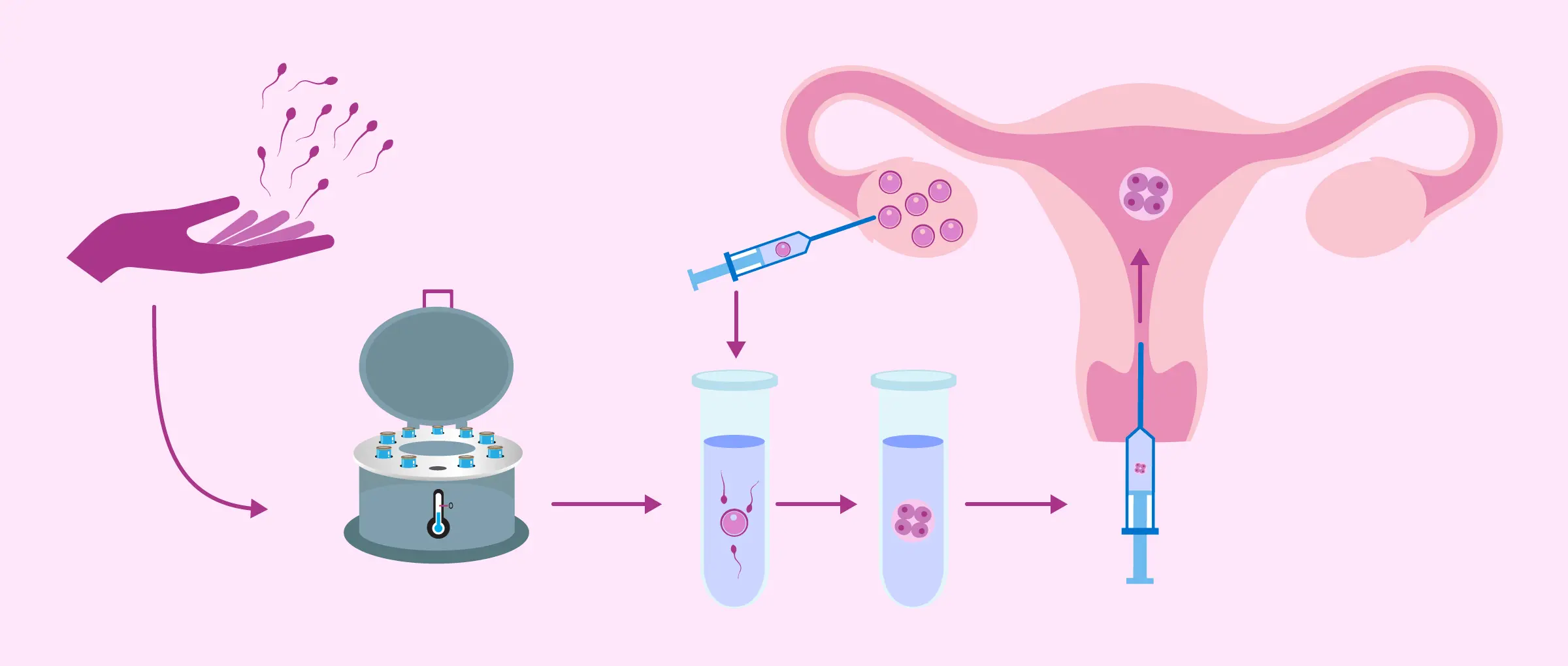 IVF with donor sperm