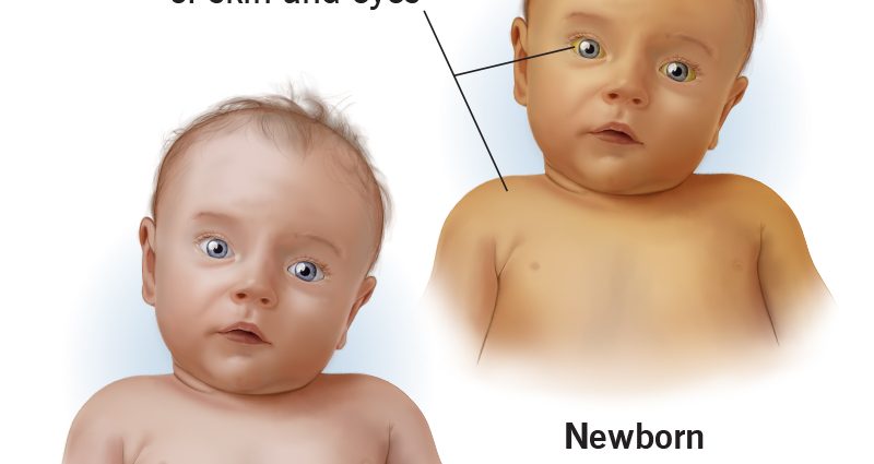 Jaundice in newborns