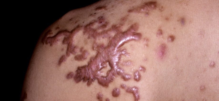 Keloid scars