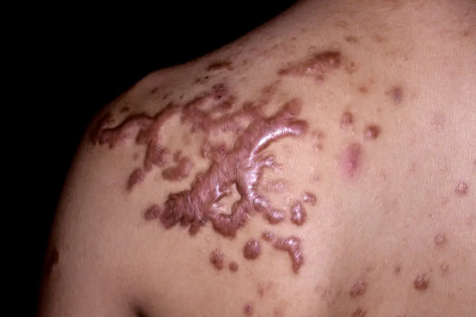 Keloid scars