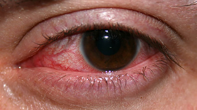 Keratitis in adults