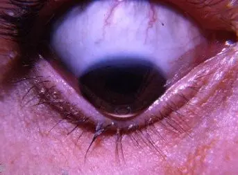 Keratoconus