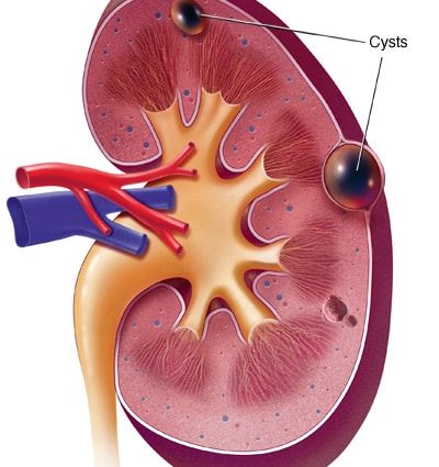 Kidney cyst in adults