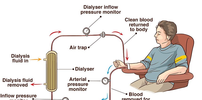 Kidney failure in adults