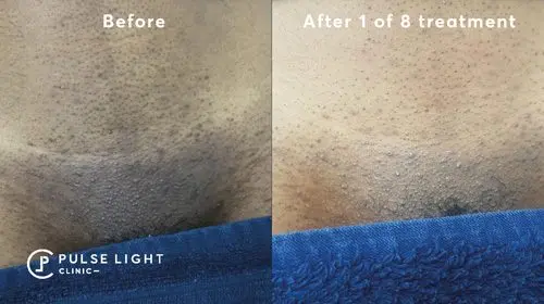 Laser hair removal bikini