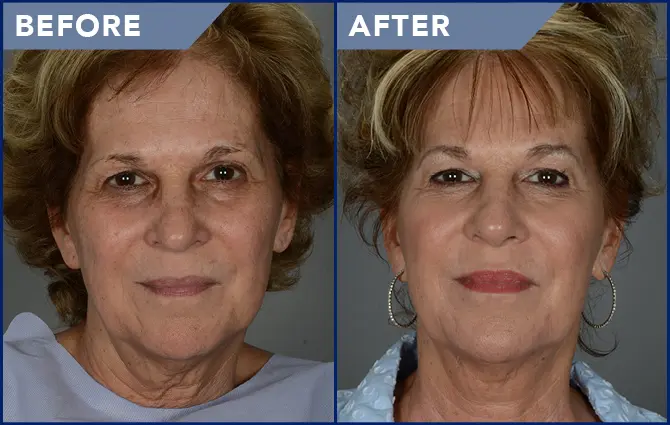 Laser resurfacing of the face