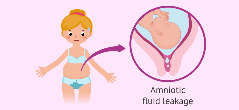 Leakage of amniotic fluid