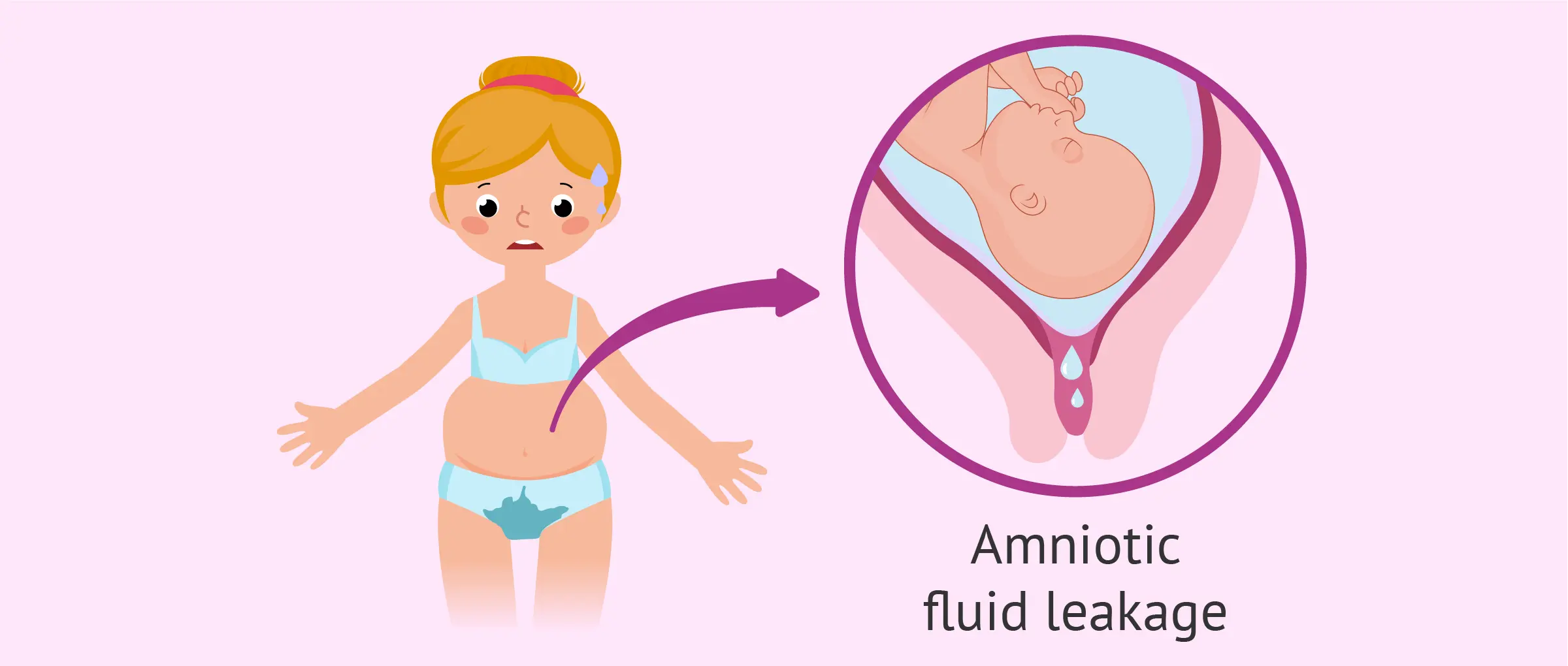 Leakage of amniotic fluid