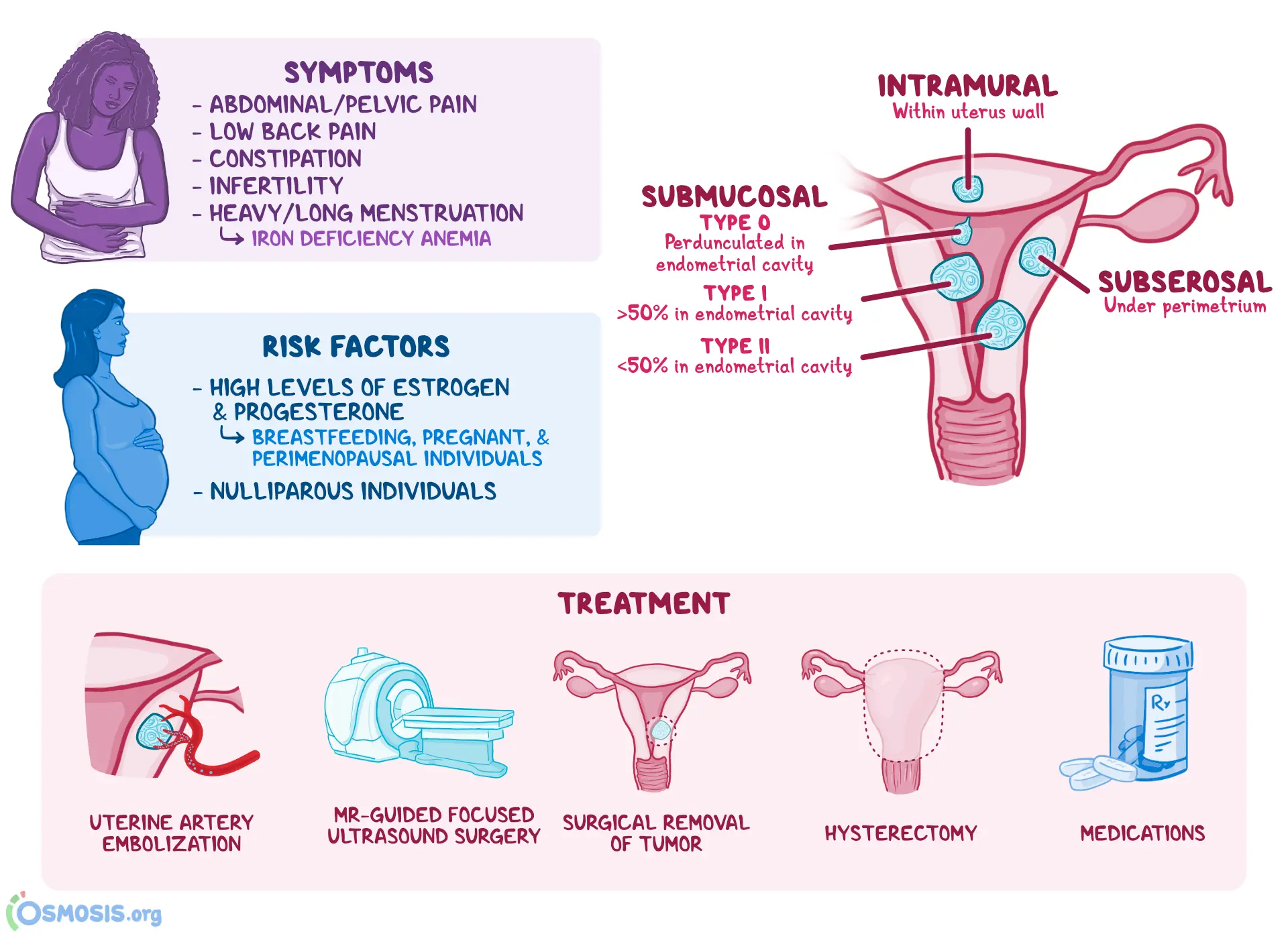 Leiomyoma of the uterus