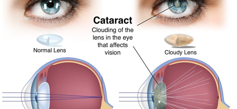 Лінзи для лікування катаракти у дорослих