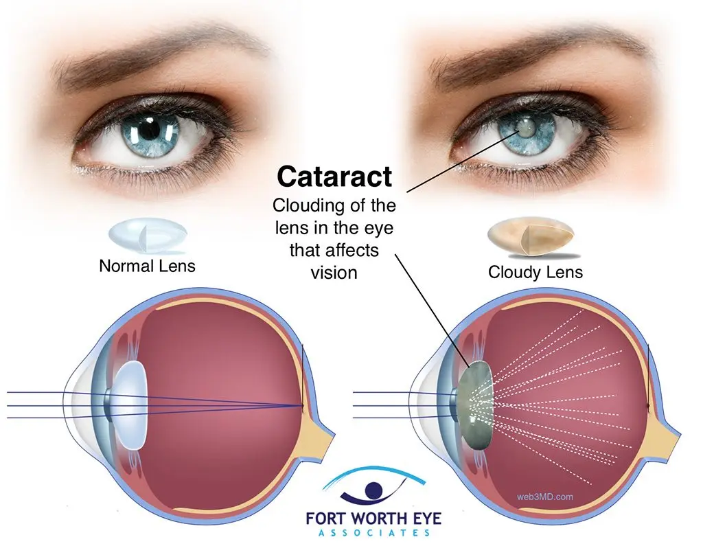 Lenses for cataracts in adults