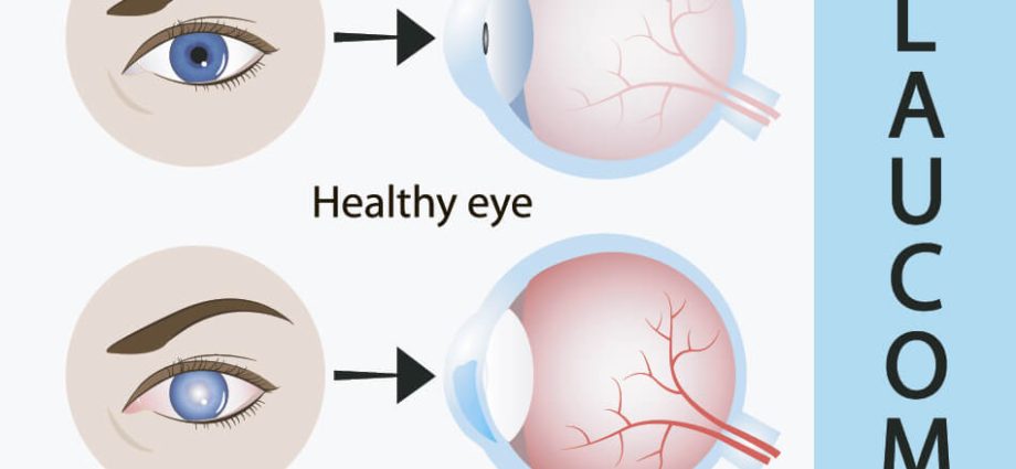 Lensa kanggo glaukoma ing wong diwasa