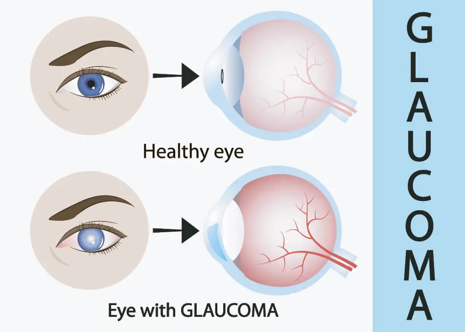 Lenses for glaucoma in adults