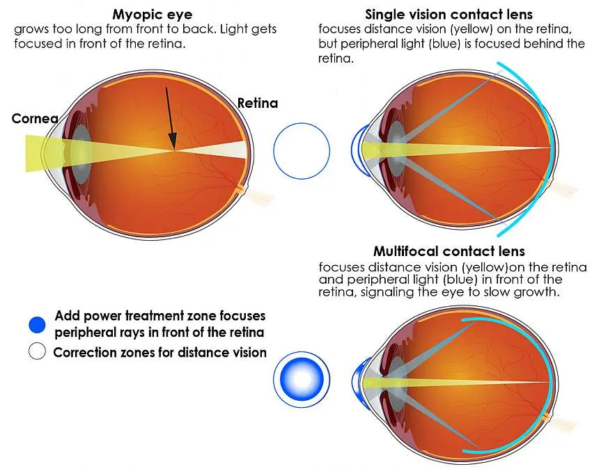 Lenses for myopia in adults