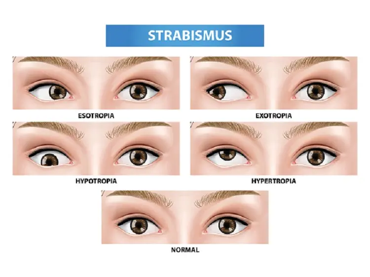 Lenses for strabismus in adults