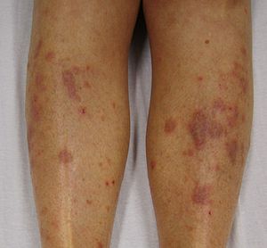 Lichen planus in adults