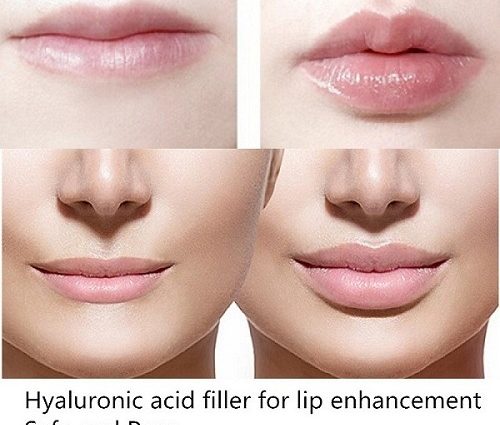 Povećanje usana hijaluronskom kiselinom
