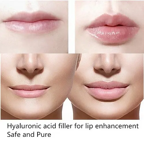 Lip augmentation with hyaluronic acid