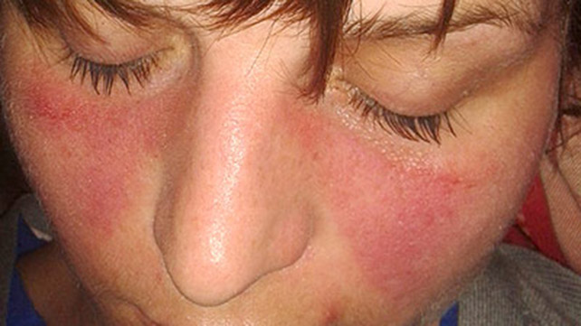 Lupus erythematosus in adults