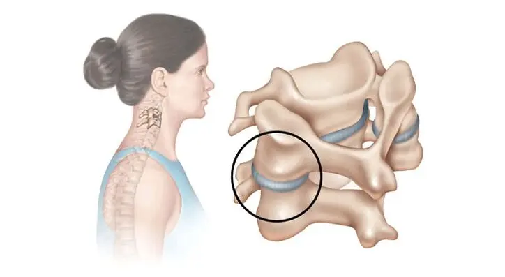 Massage for osteochondrosis of the cervical spine for adults