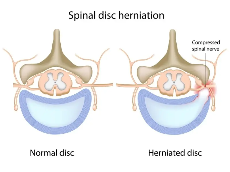 Massage for spinal hernia for adults