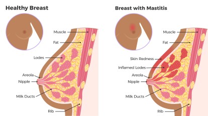 Mastitis in breastfeeding women