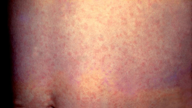 Measles in adults