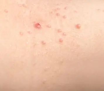 Molluscum contagiosum in adults