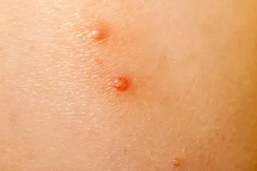 Molluscum contagiosum in children