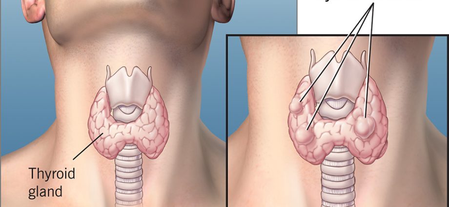 Nodular thyroid goiter in adults