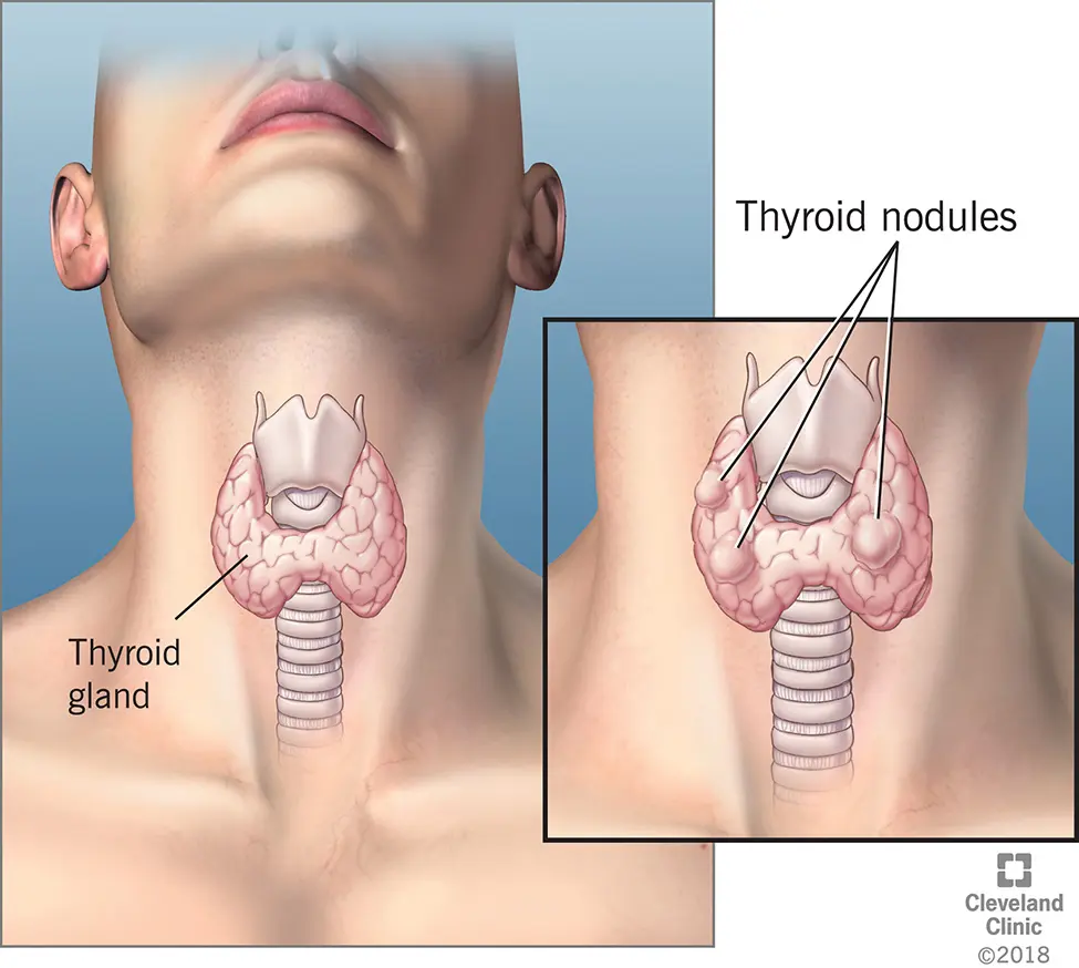 Nodular thyroid goiter in adults