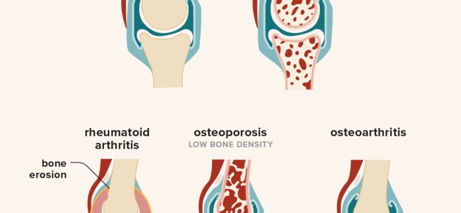 Osteoarthritis in adults