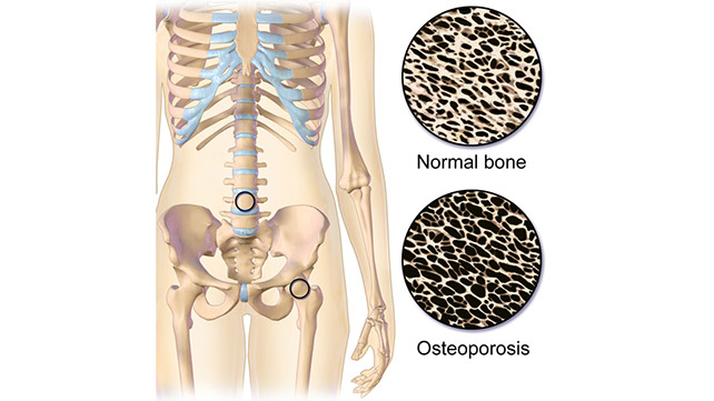 Osteoporosis in adults