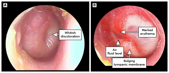 Otitis in adults