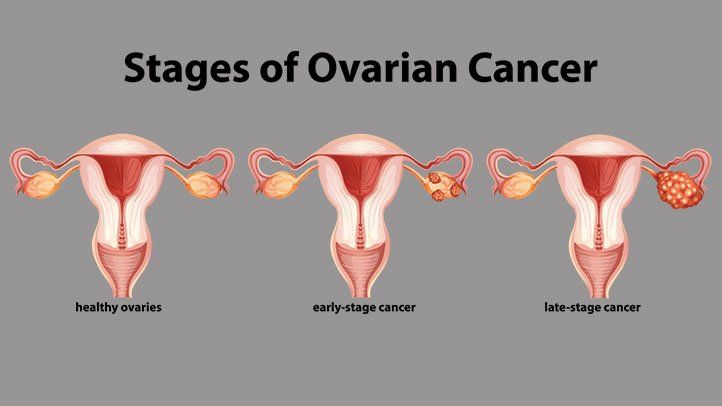 Ovarian cancer