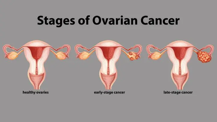 Ovarian cancer