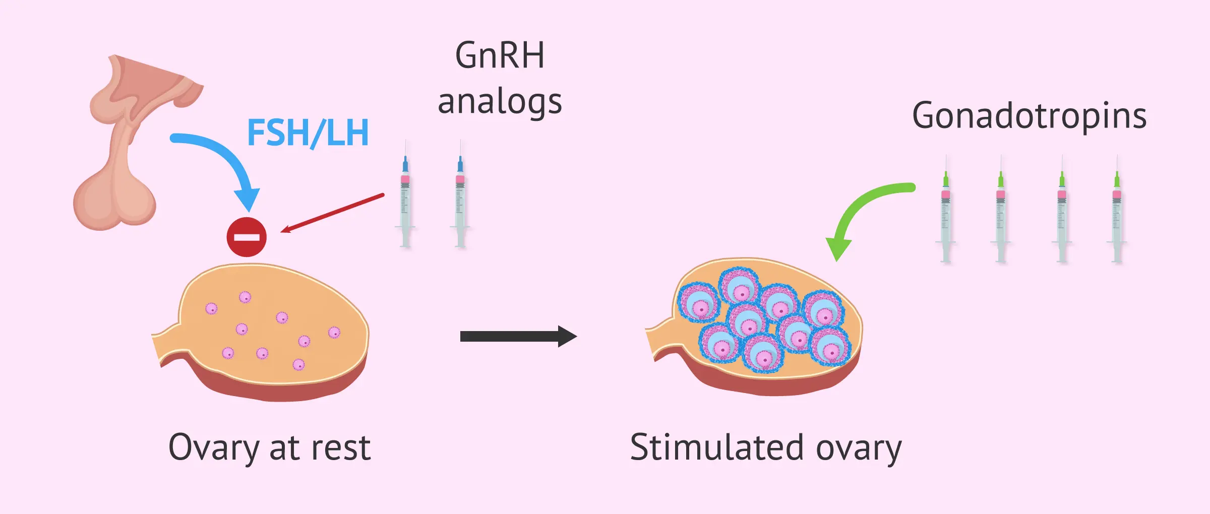 Ovarian stimulation in IVF