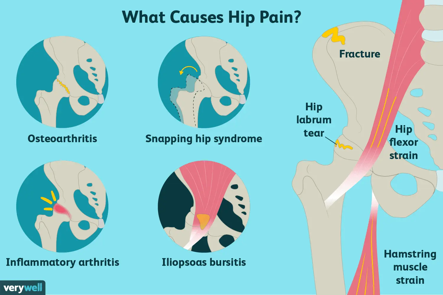 Pain in the hip joint