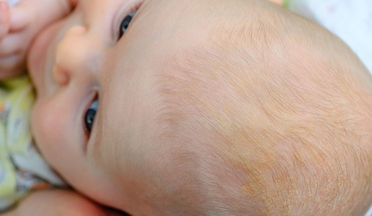 Peeling scalp in a child