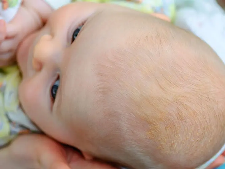 Peeling scalp in a child