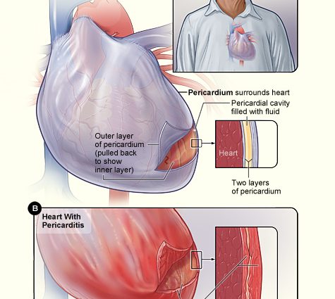 Pericarditis in adults