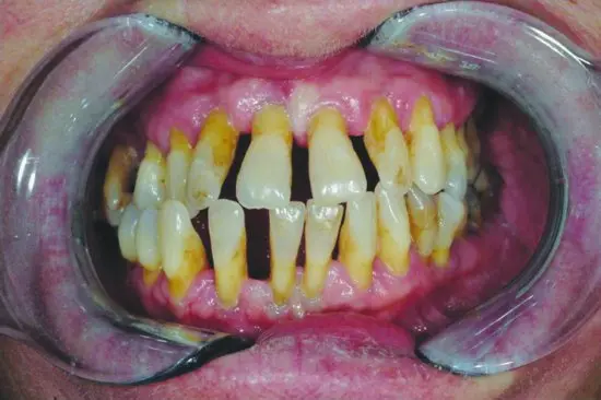 Periodontitis in adults