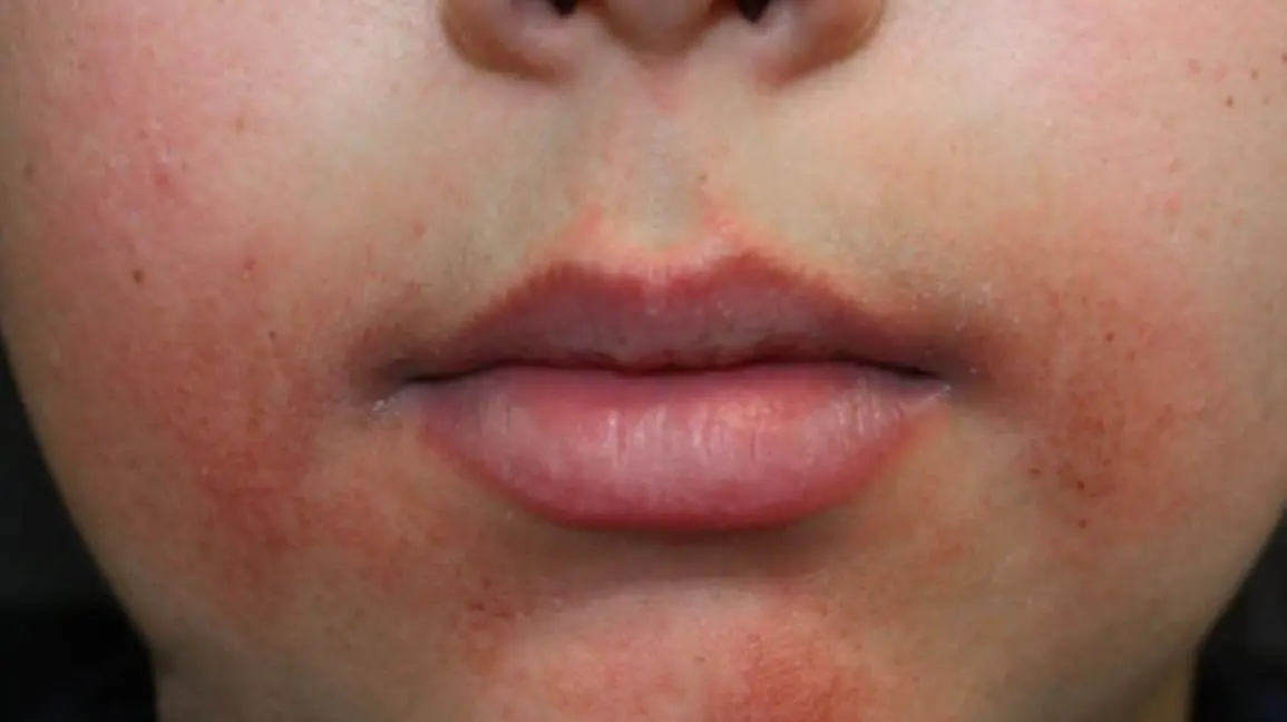 Perioral dermatitis in adults