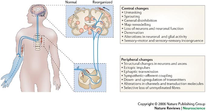 Phantom pain in adults