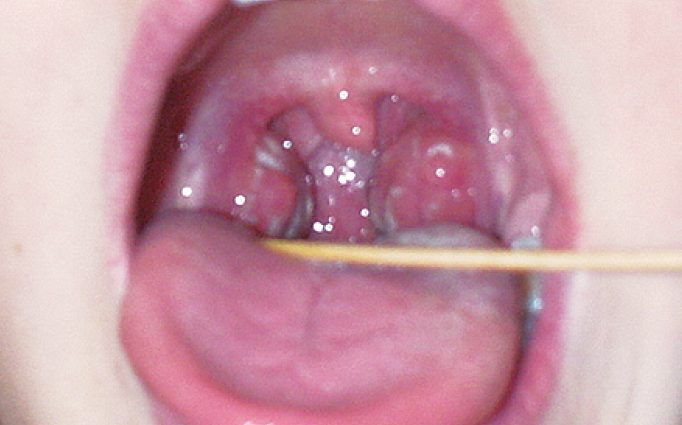 Pharyngitis in children