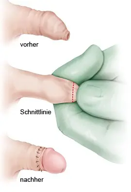 Phimosis in men