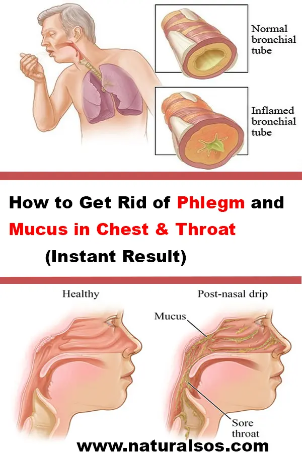 Phlegm in the throat