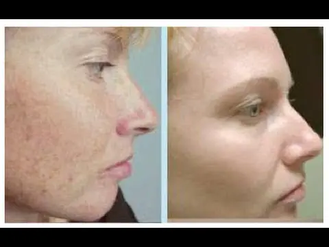 Photorejuvenation of the face