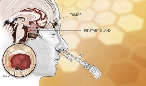 Pituitary adenoma in adults