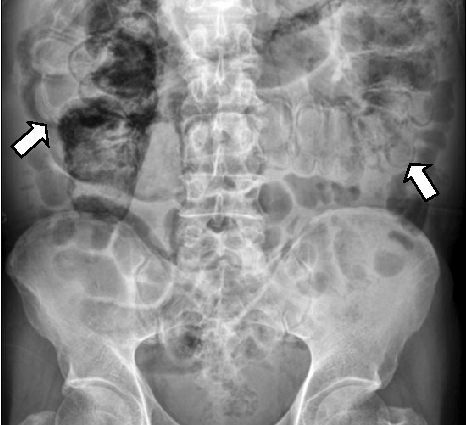 Pneumatosis in adults